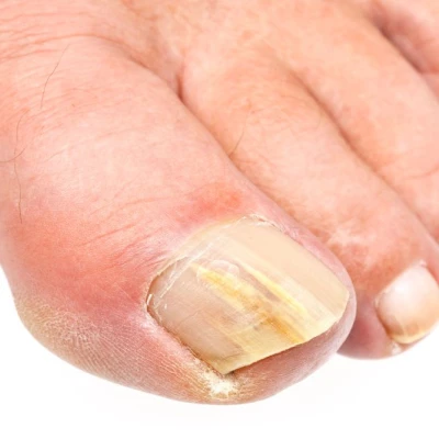 Fungal nail infection: what are the symptoms? And how do you treat it? 