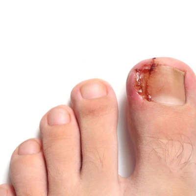 How to recognise and treat an ingrown toenail? 