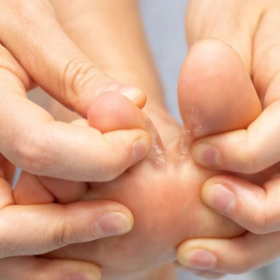 Athlete's foot: causes, symptoms and treatment 