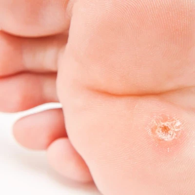 Callus : what is it and how to treat it ? 