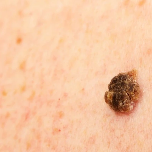 What is seborrheic keratosis? 