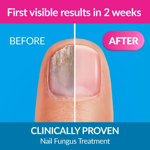 Nail Fungus Solution