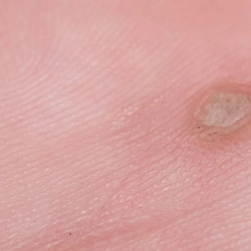 What are the different types of warts?