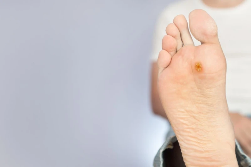 How to tell if a wart is dying?