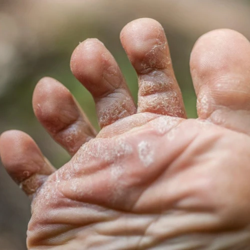 Mycose du pied : symptômes, causes et traitement