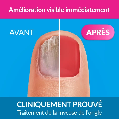  Mycose de l'ongle Forte Color