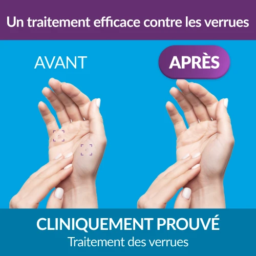 Traitement des verrues Cryo