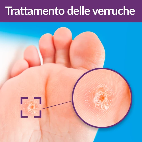 Warts Trattamento 2 in 1